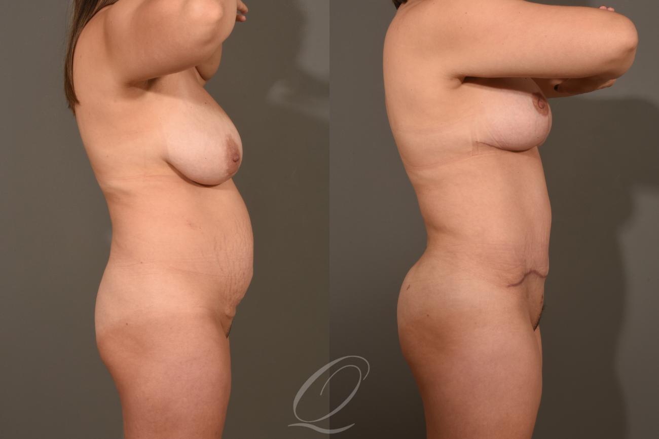 Breast Lift Case 1001324 Before & After Right Side | Serving Rochester, Syracuse & Buffalo, NY | Quatela Center for Plastic Surgery