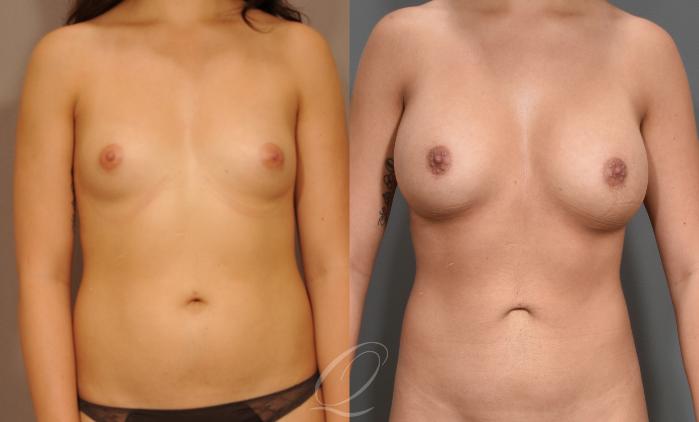 Breast Augmentation Case 1001527 Before & After Front | Serving Rochester, Syracuse & Buffalo, NY | Quatela Center for Plastic Surgery