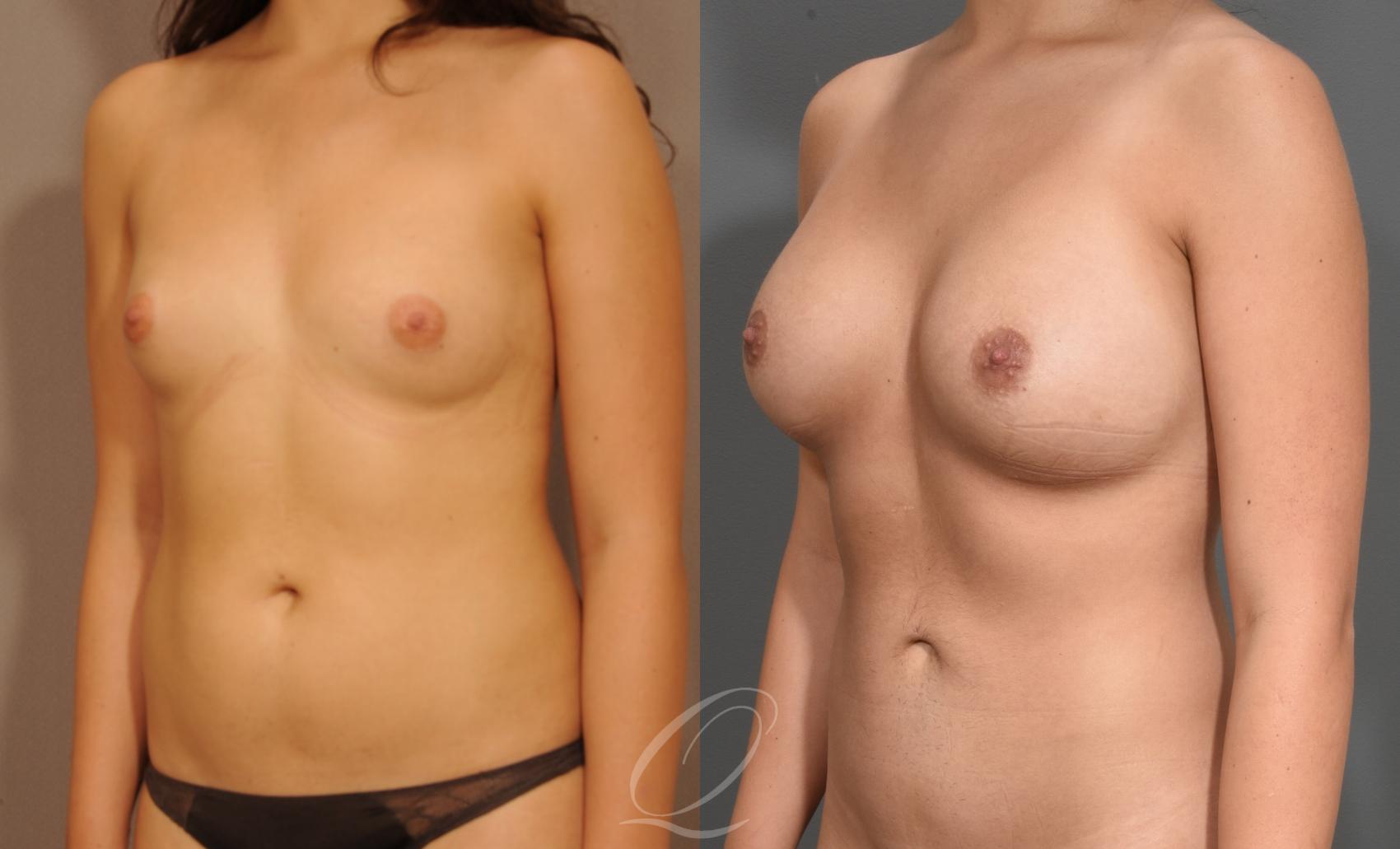 Mommy Makeover Case 1001527 Before & After Left Oblique | Serving Rochester, Syracuse & Buffalo, NY | Quatela Center for Plastic Surgery