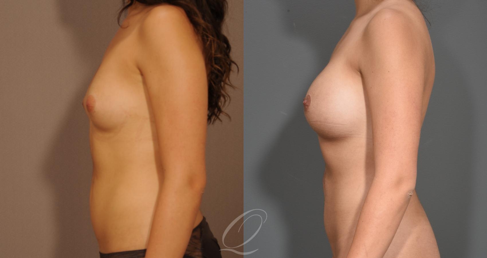 Mommy Makeover Case 1001527 Before & After Left Side | Serving Rochester, Syracuse & Buffalo, NY | Quatela Center for Plastic Surgery