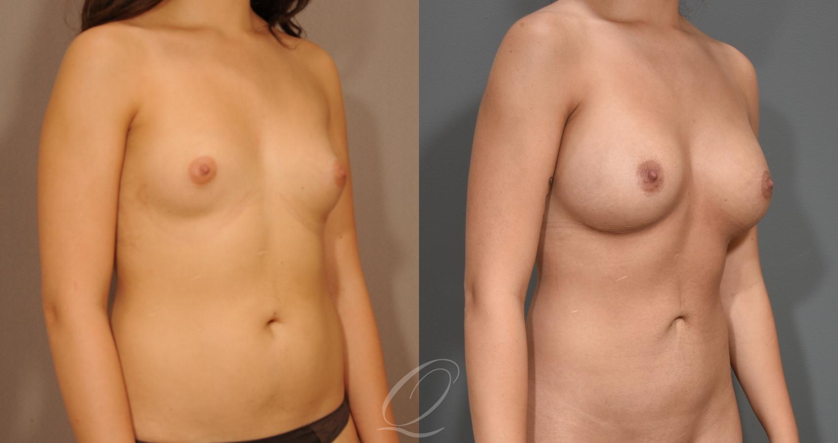 Mommy Makeover Case 1001527 Before & After Right Oblique | Serving Rochester, Syracuse & Buffalo, NY | Quatela Center for Plastic Surgery
