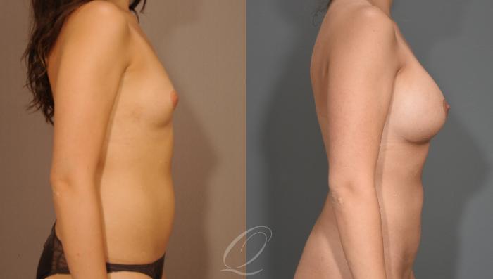 Breast Augmentation Case 1001527 Before & After Right Side | Serving Rochester, Syracuse & Buffalo, NY | Quatela Center for Plastic Surgery