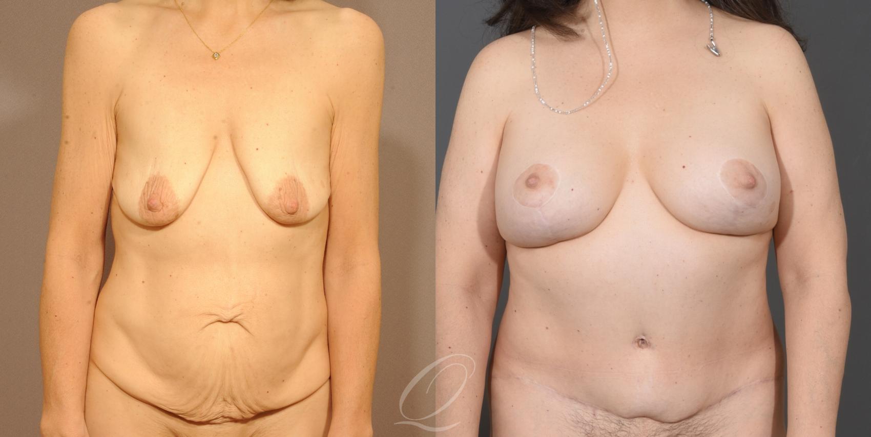 Tummy Tuck Case 1001530 Before & After Front | Serving Rochester, Syracuse & Buffalo, NY | Quatela Center for Plastic Surgery