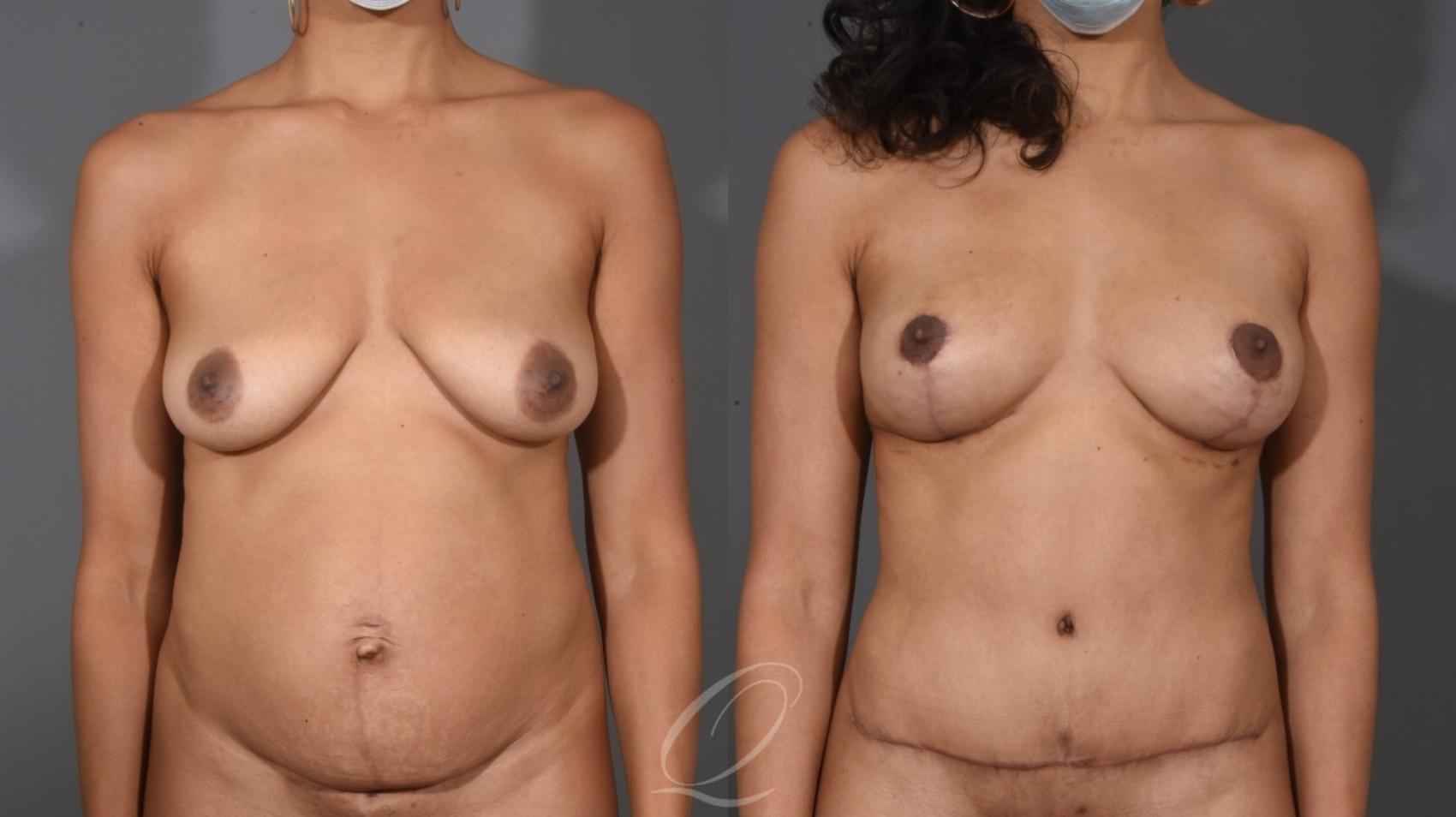 Breast Lift Case 1001531 Before & After Front | Serving Rochester, Syracuse & Buffalo, NY | Quatela Center for Plastic Surgery