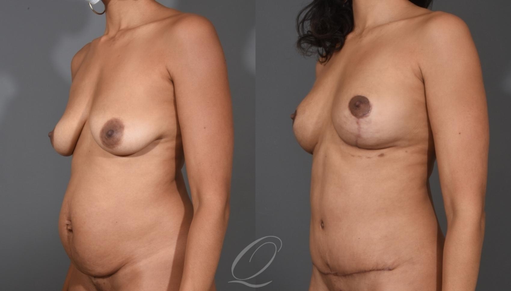 Breast Augmentation with Fat Transfer Case 1001531 Before & After Left Oblique | Serving Rochester, Syracuse & Buffalo, NY | Quatela Center for Plastic Surgery
