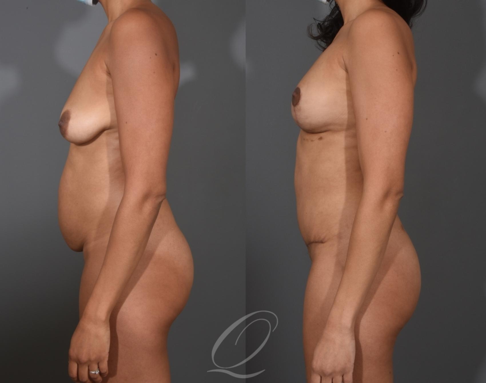 Breast Augmentation with Fat Transfer Case 1001531 Before & After Left Side | Serving Rochester, Syracuse & Buffalo, NY | Quatela Center for Plastic Surgery