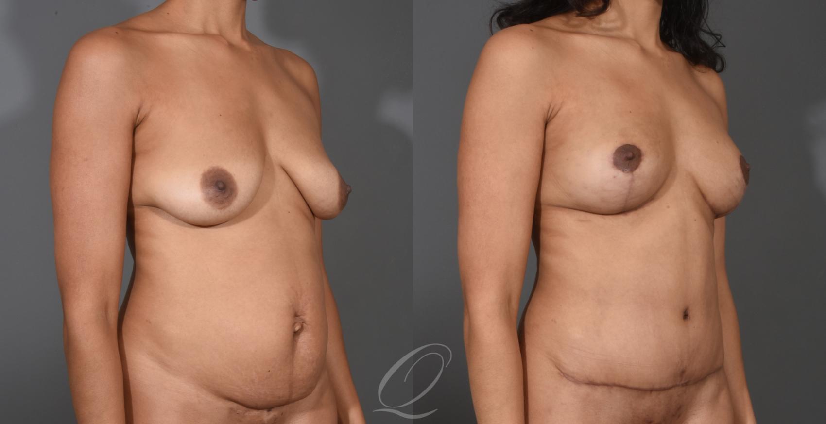 Breast Augmentation with Fat Transfer Case 1001531 Before & After Right Oblique | Serving Rochester, Syracuse & Buffalo, NY | Quatela Center for Plastic Surgery
