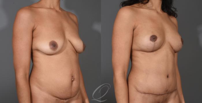 Tummy Tuck Case 1001531 Before & After Right Oblique | Serving Rochester, Syracuse & Buffalo, NY | Quatela Center for Plastic Surgery