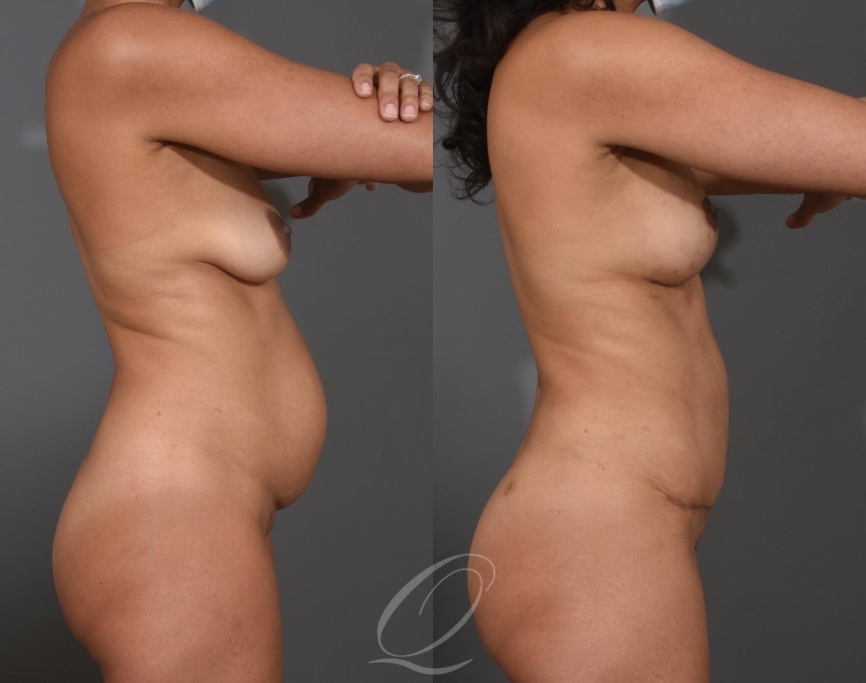 Breast Augmentation with Fat Transfer Case 1001531 Before & After Right Side | Serving Rochester, Syracuse & Buffalo, NY | Quatela Center for Plastic Surgery