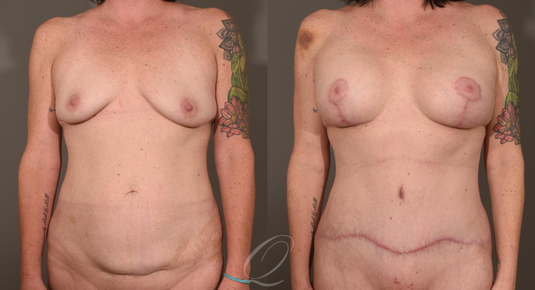 Breast Augmentation with Lift Case 1001532 Before & After Front | Serving Rochester, Syracuse & Buffalo, NY | Quatela Center for Plastic Surgery