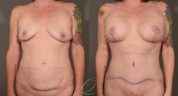 Tummy Tuck Case 1001532 Before & After Front | Serving Rochester, Syracuse & Buffalo, NY | Quatela Center for Plastic Surgery