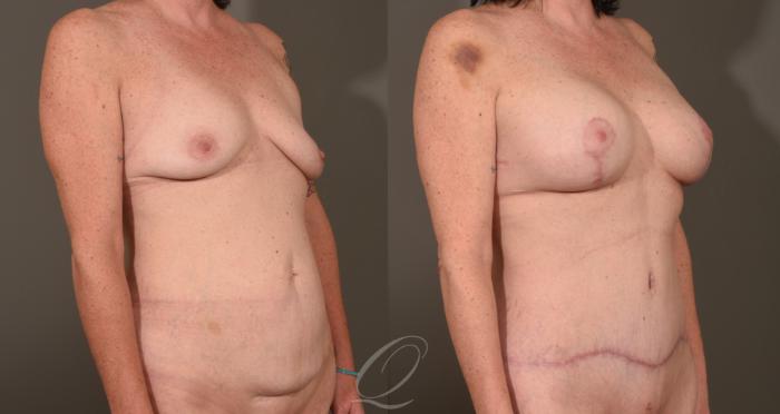 Tummy Tuck Case 1001532 Before & After Right Oblique | Serving Rochester, Syracuse & Buffalo, NY | Quatela Center for Plastic Surgery