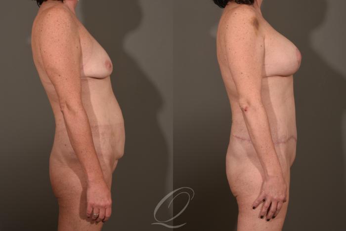 Breast Augmentation with Lift Case 1001532 Before & After Right Side | Serving Rochester, Syracuse & Buffalo, NY | Quatela Center for Plastic Surgery