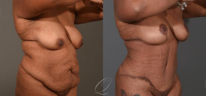 Breast Lift Case 1001533 Before & After Right Oblique | Serving Rochester, Syracuse & Buffalo, NY | Quatela Center for Plastic Surgery