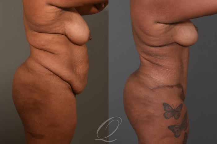 Tummy Tuck Case 1001533 Before & After Right Side | Serving Rochester, Syracuse & Buffalo, NY | Quatela Center for Plastic Surgery