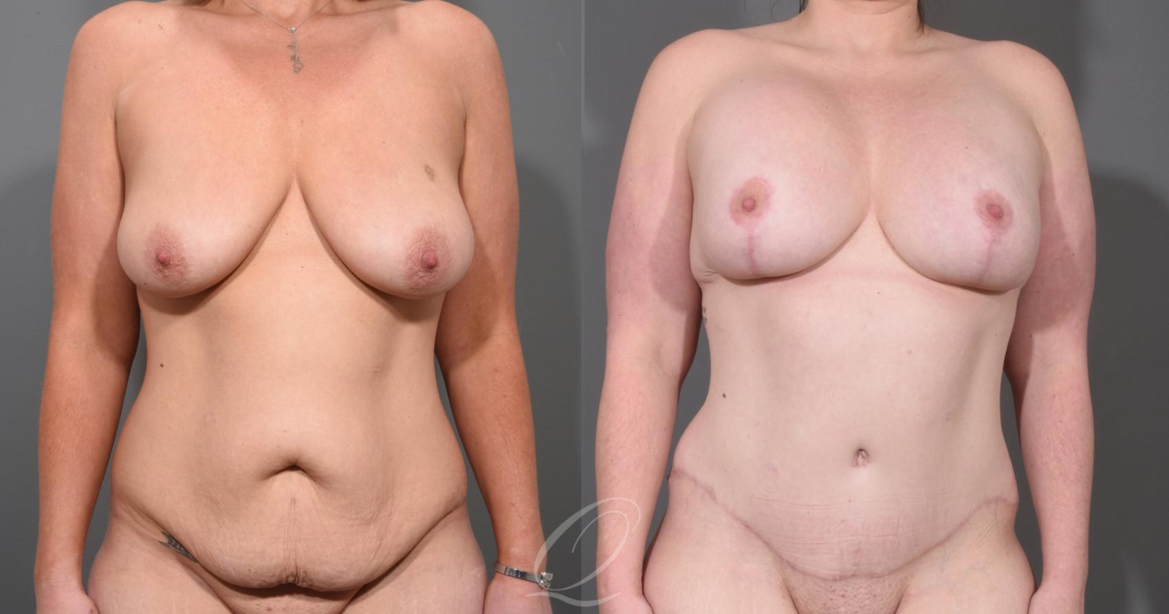 Mommy Makeover Case 1001534 Before & After Front | Serving Rochester, Syracuse & Buffalo, NY | Quatela Center for Plastic Surgery