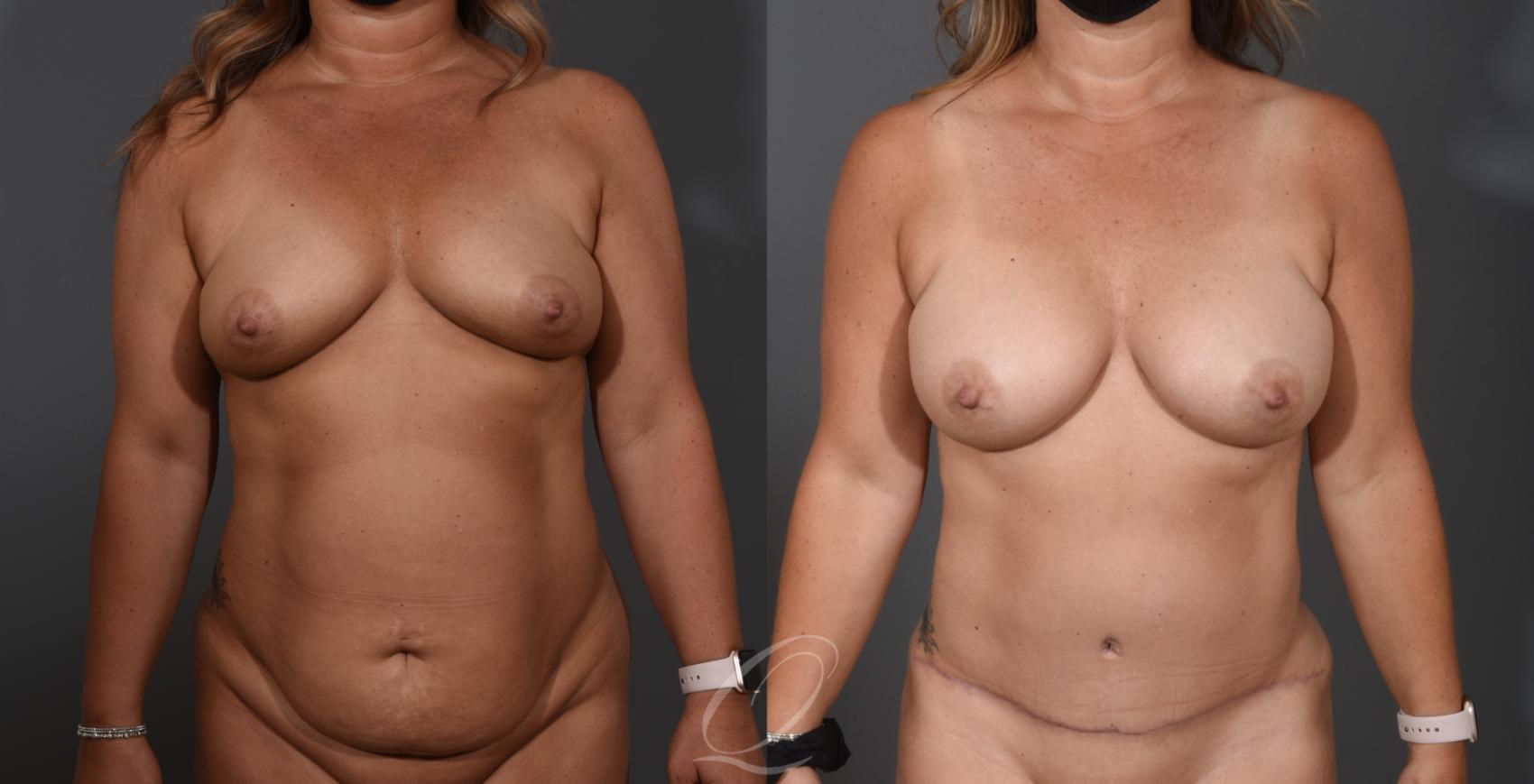 Tummy Tuck Case 1001535 Before & After Front | Serving Rochester, Syracuse & Buffalo, NY | Quatela Center for Plastic Surgery