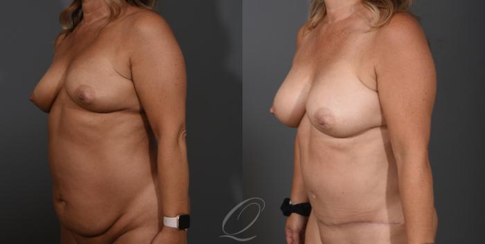 Breast Augmentation Case 1001535 Before & After Left Oblique | Serving Rochester, Syracuse & Buffalo, NY | Quatela Center for Plastic Surgery
