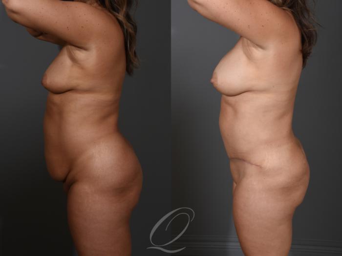 Breast Augmentation Case 1001535 Before & After Left Side | Serving Rochester, Syracuse & Buffalo, NY | Quatela Center for Plastic Surgery