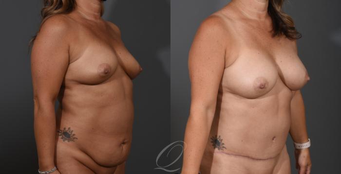 Mommy Makeover Case 1001535 Before & After Right Oblique | Serving Rochester, Syracuse & Buffalo, NY | Quatela Center for Plastic Surgery
