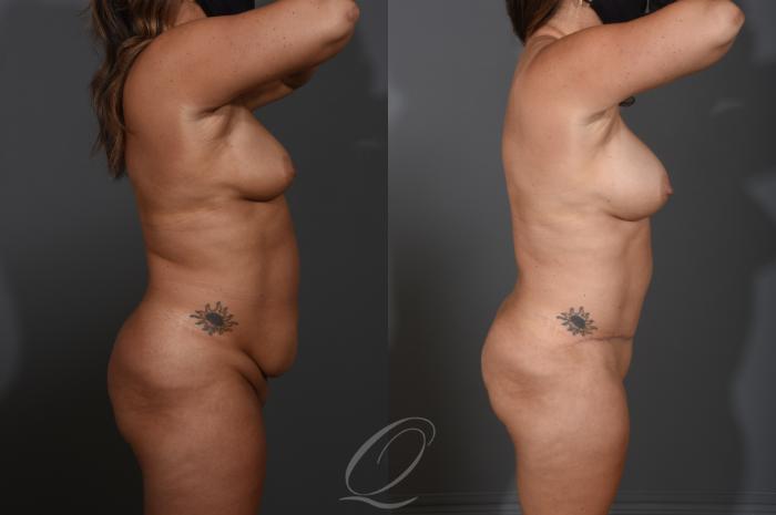 Tummy Tuck Case 1001535 Before & After Right Side | Serving Rochester, Syracuse & Buffalo, NY | Quatela Center for Plastic Surgery