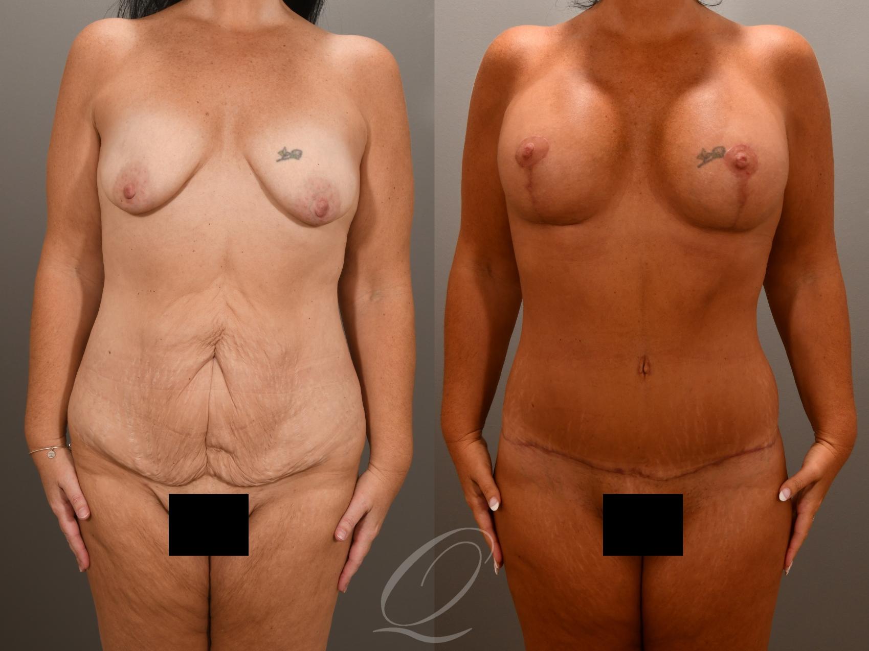 Breast Augmentation with Lift Case 1001619 Before & After Front | Serving Rochester, Syracuse & Buffalo, NY | Quatela Center for Plastic Surgery