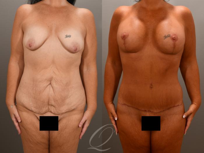 Mommy Makeover Case 1001619 Before & After Front | Serving Rochester, Syracuse & Buffalo, NY | Quatela Center for Plastic Surgery