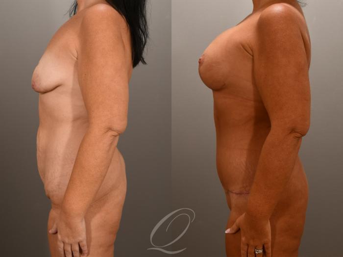 Tummy Tuck Case 1001619 Before & After Left Side | Serving Rochester, Syracuse & Buffalo, NY | Quatela Center for Plastic Surgery