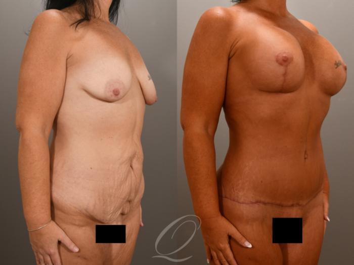 Breast Augmentation with Lift Case 1001619 Before & After Right Oblique | Serving Rochester, Syracuse & Buffalo, NY | Quatela Center for Plastic Surgery