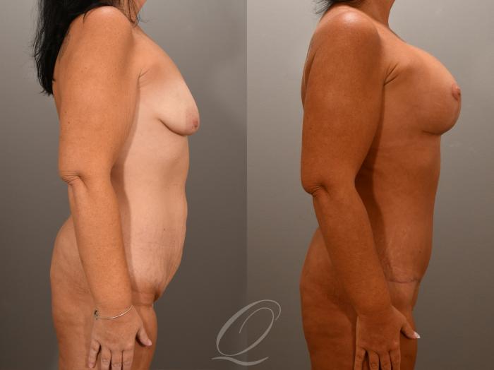 Breast Augmentation with Lift Case 1001619 Before & After Right Side | Serving Rochester, Syracuse & Buffalo, NY | Quatela Center for Plastic Surgery
