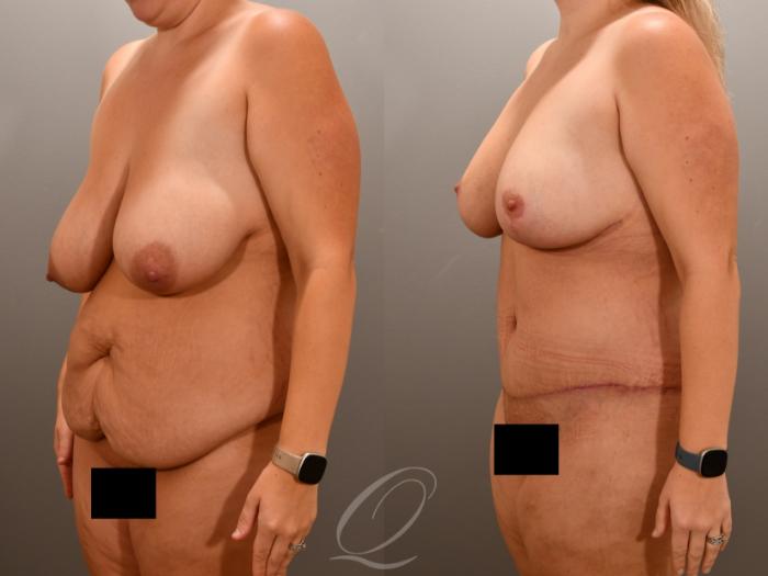 Breast Lift Case 1001648 Before & After Left Oblique | Serving Rochester, Syracuse & Buffalo, NY | Quatela Center for Plastic Surgery