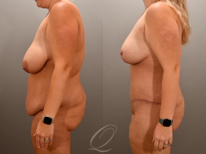 Breast Lift Case 1001648 Before & After Left Side | Serving Rochester, Syracuse & Buffalo, NY | Quatela Center for Plastic Surgery