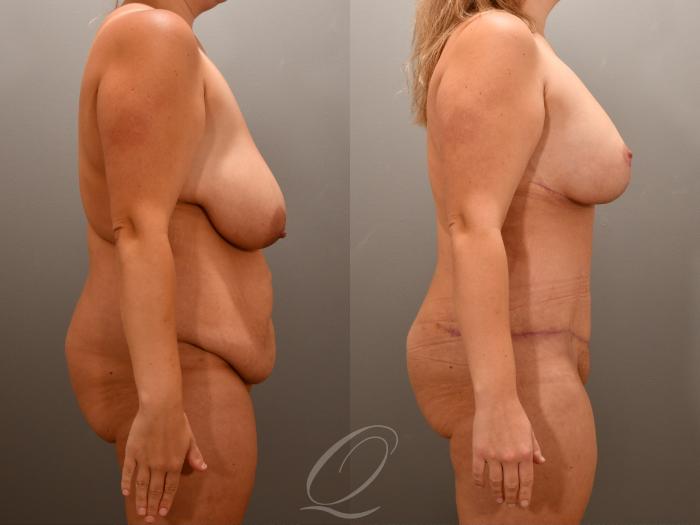 Mommy Makeover Case 1001648 Before & After Right Side | Serving Rochester, Syracuse & Buffalo, NY | Quatela Center for Plastic Surgery