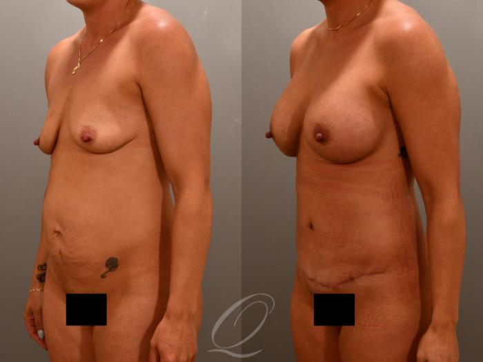 Breast Augmentation Case 1001649 Before & After Left Oblique | Serving Rochester, Syracuse & Buffalo, NY | Quatela Center for Plastic Surgery