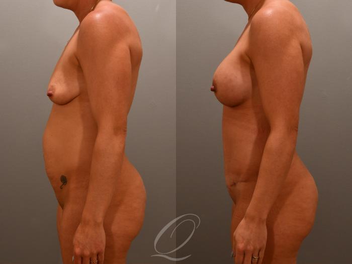 Mommy Makeover Case 1001649 Before & After Left Side | Serving Rochester, Syracuse & Buffalo, NY | Quatela Center for Plastic Surgery