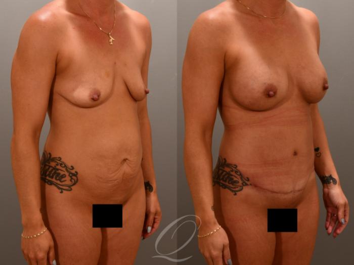 Breast Augmentation Case 1001649 Before & After Right Oblique | Serving Rochester, Syracuse & Buffalo, NY | Quatela Center for Plastic Surgery
