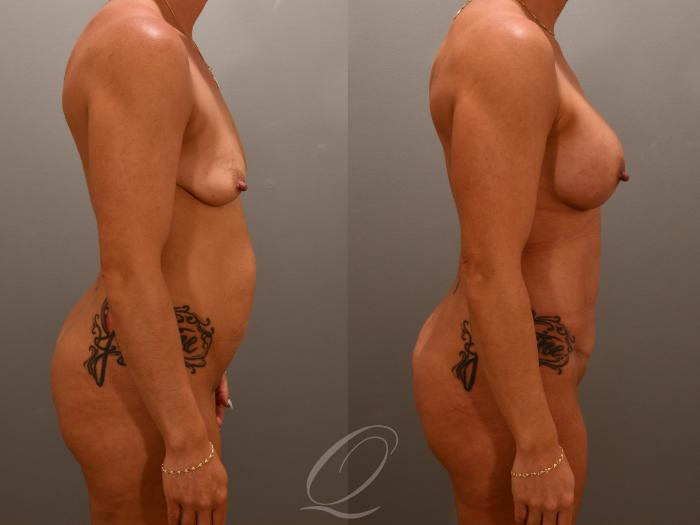 Breast Augmentation Case 1001649 Before & After Right Side | Serving Rochester, Syracuse & Buffalo, NY | Quatela Center for Plastic Surgery