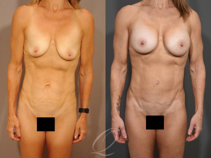 Mommy Makeover Case 1001650 Before & After Front | Serving Rochester, Syracuse & Buffalo, NY | Quatela Center for Plastic Surgery