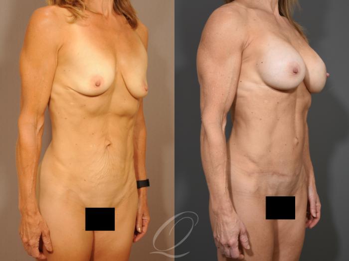 Breast Augmentation Case 1001650 Before & After Right Oblique | Serving Rochester, Syracuse & Buffalo, NY | Quatela Center for Plastic Surgery
