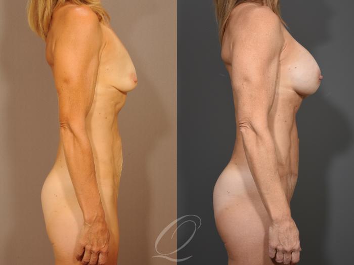 Tummy Tuck Case 1001650 Before & After Right Side | Serving Rochester, Syracuse & Buffalo, NY | Quatela Center for Plastic Surgery