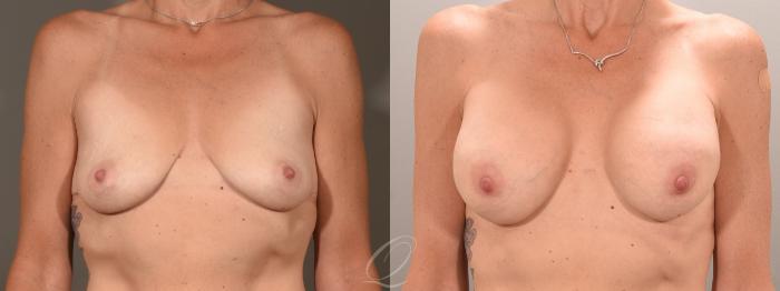 Tummy Tuck Case 1001651 Before & After Breast Front View | Serving Rochester, Syracuse & Buffalo, NY | Quatela Center for Plastic Surgery