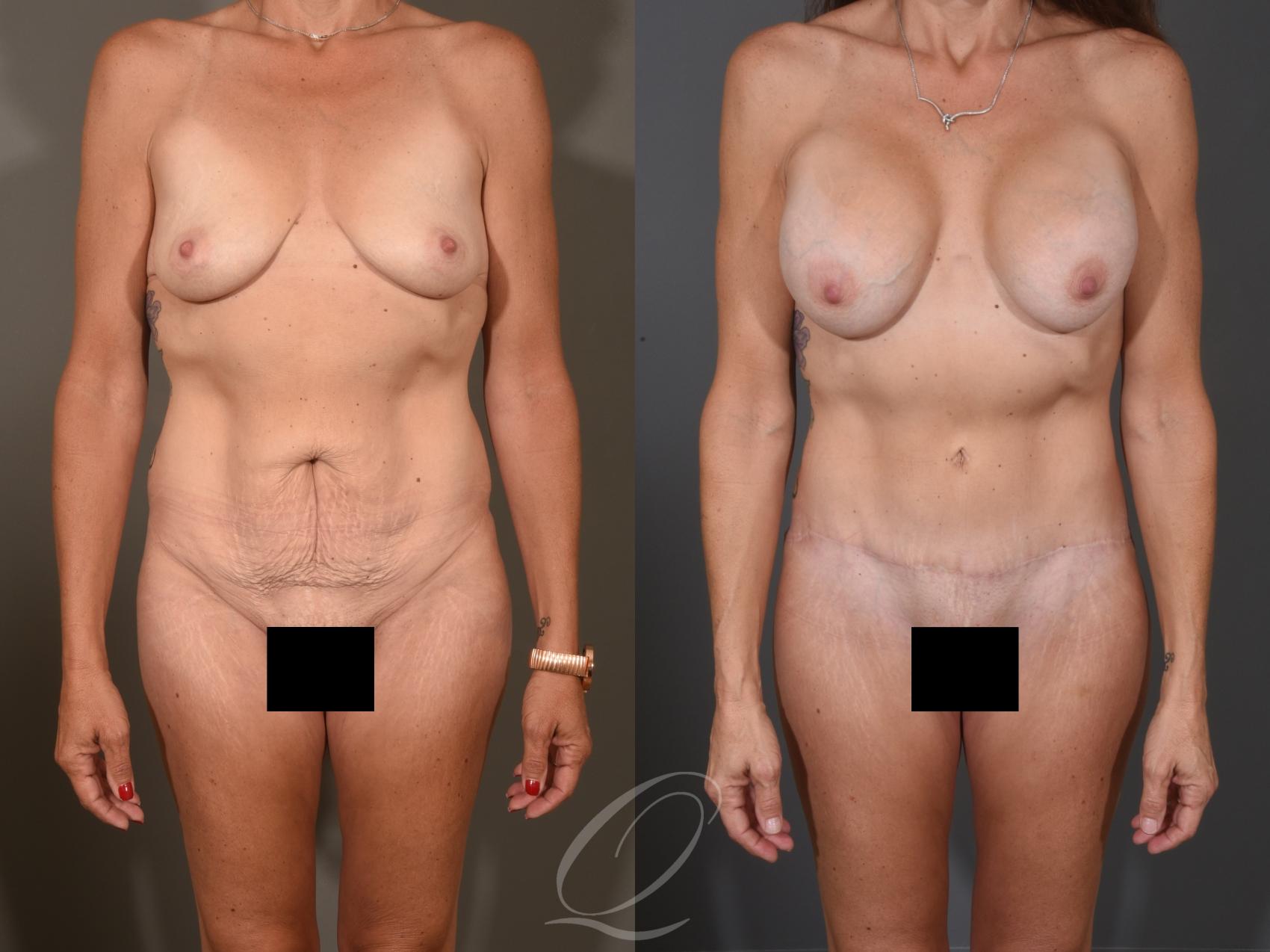 Tummy Tuck Case 1001651 Before & After Front | Serving Rochester, Syracuse & Buffalo, NY | Quatela Center for Plastic Surgery