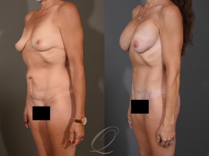 Breast Augmentation Case 1001651 Before & After Left Oblique | Serving Rochester, Syracuse & Buffalo, NY | Quatela Center for Plastic Surgery