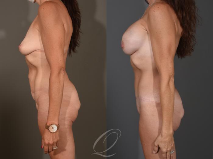 Breast Augmentation Case 1001651 Before & After Left Side | Serving Rochester, Syracuse & Buffalo, NY | Quatela Center for Plastic Surgery