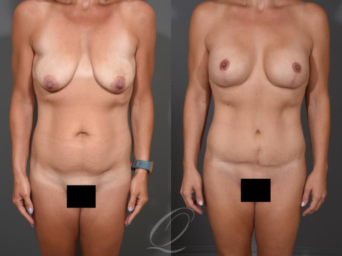 Tummy Tuck Case 1001652 Before & After Front | Serving Rochester, Syracuse & Buffalo, NY | Quatela Center for Plastic Surgery