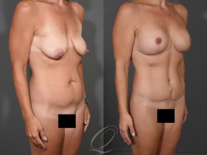 Mommy Makeover Case 1001652 Before & After Right Oblique | Serving Rochester, Syracuse & Buffalo, NY | Quatela Center for Plastic Surgery