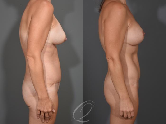 Breast Augmentation with Lift Case 1001652 Before & After Right Side | Serving Rochester, Syracuse & Buffalo, NY | Quatela Center for Plastic Surgery