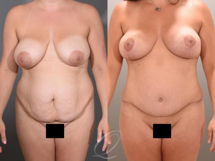 Tummy Tuck Case 1001653 Before & After Front | Serving Rochester, Syracuse & Buffalo, NY | Quatela Center for Plastic Surgery