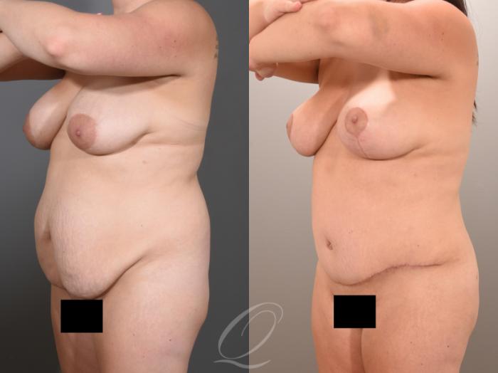 Tummy Tuck Case 1001653 Before & After Left Oblique | Serving Rochester, Syracuse & Buffalo, NY | Quatela Center for Plastic Surgery
