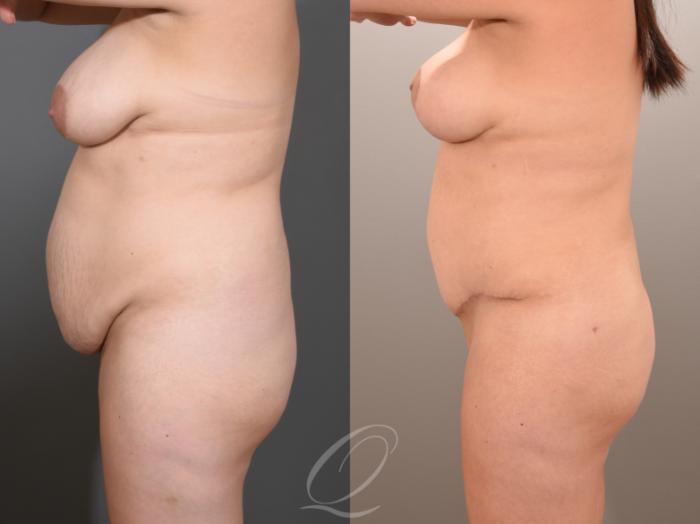 Mommy Makeover Case 1001653 Before & After Left Side | Serving Rochester, Syracuse & Buffalo, NY | Quatela Center for Plastic Surgery